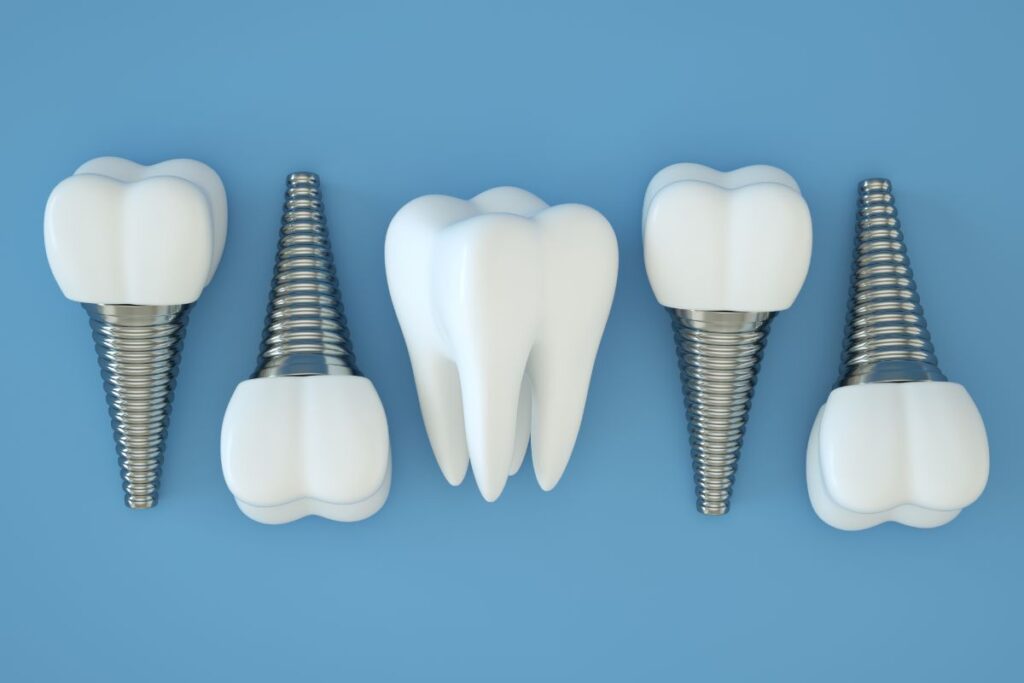 How to Prepare & Care for Dental Implants