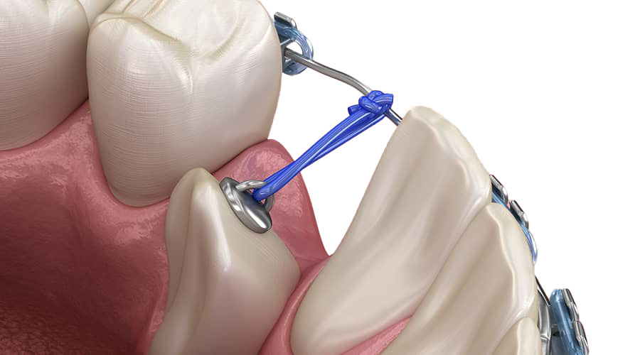 a tooth connected to braces for exposure and bond